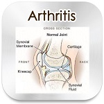 arthritis remedy
