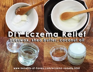 eczema remedy with honey poster