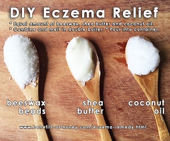 eczema remedy with honey poster