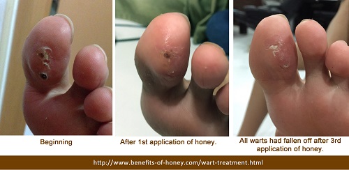 wart treatment testimony image